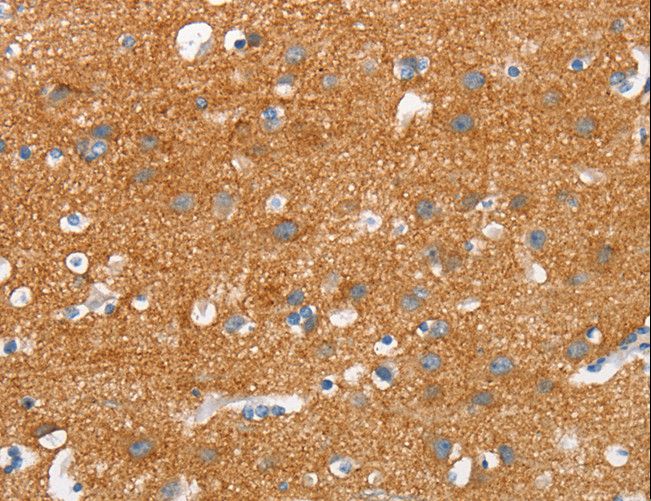 SNCA / Alpha-Synuclein Antibody - Immunohistochemistry of paraffin-embedded Human thyroid cancer using SNCA Polyclonal Antibody at dilution of 1:30.