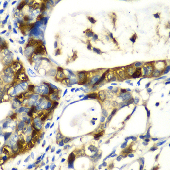 SNCA / Alpha-Synuclein Antibody - Immunohistochemistry of paraffin-embedded human gastric cancer using SNCA antibody at dilution of 1:100 (40x lens).