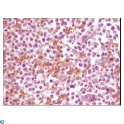 SNCA / Alpha-Synuclein Antibody - Immunohistochemistry (IHC) analysis of paraffin-embedded human glioma tissue, showing membrane localization with DAB staining using Synuclein-alpha Monoclonal Antibody.