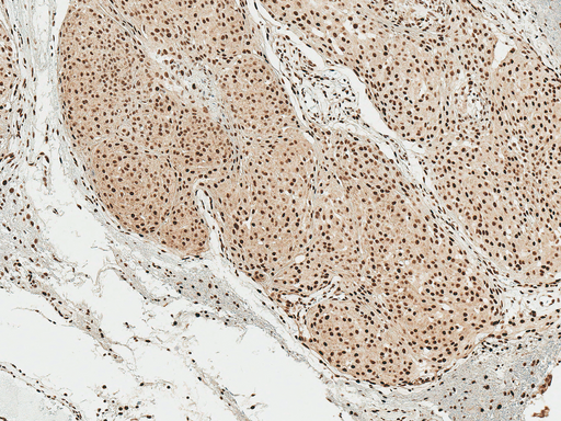 SNCA / Alpha-Synuclein Antibody - Immunohistochemistry analysis using Rabbit Anti-Alpha Synuclein pSer129 Polyclonal Antibody. Tissue: Brain. Species: Human. Fixation: Formalin Fixed Paraffin-Embedded. Primary Antibody: Rabbit Anti-Alpha Synuclein pSer129 Polyclonal Antibody  at 1:50 for 30 min at RT. Counterstain: Hematoxylin. Magnification: 10X. HRP-DAB Detection.