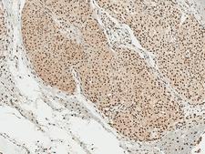 SNCA / Alpha-Synuclein Antibody - Immunohistochemistry analysis using Rabbit Anti-Alpha Synuclein pSer129 Polyclonal Antibody. Tissue: Brain. Species: Human. Fixation: Formalin Fixed Paraffin-Embedded. Primary Antibody: Rabbit Anti-Alpha Synuclein pSer129 Polyclonal Antibody  at 1:50 for 30 min at RT. Counterstain: Hematoxylin. Magnification: 10X. HRP-DAB Detection.