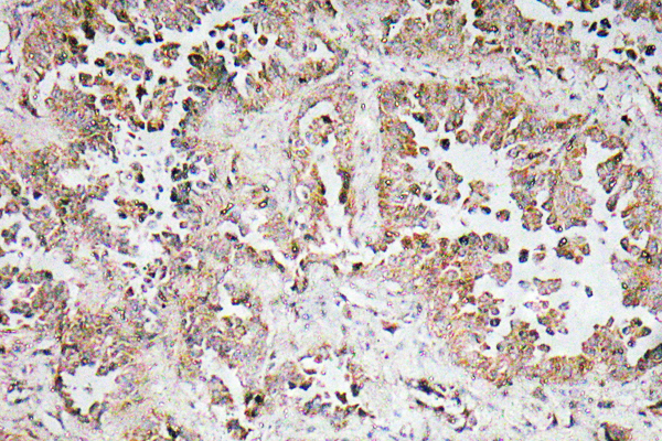 SNCAIP / Synphilin 1 Antibody - Immunohistochemistry analysis of Synphilin-1 antibody in paraffin-embedded lung carcinoma. tissue.