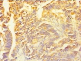 SNCG / Gamma-Synuclein Antibody - Immunohistochemistry of paraffin-embedded human ovarian cancer using antibody at 1:100 dilution.  This image was taken for the unconjugated form of this product. Other forms have not been tested.