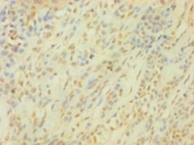 SNCG / Gamma-Synuclein Antibody - Immunohistochemistry of paraffin-embedded human breast cancer using antibody at 1:100 dilution.  This image was taken for the unconjugated form of this product. Other forms have not been tested.