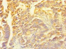 SNCG / Gamma-Synuclein Antibody - Immunohistochemistry of paraffin-embedded human ovarian cancer using antibody at 1:100 dilution.  This image was taken for the unconjugated form of this product. Other forms have not been tested.
