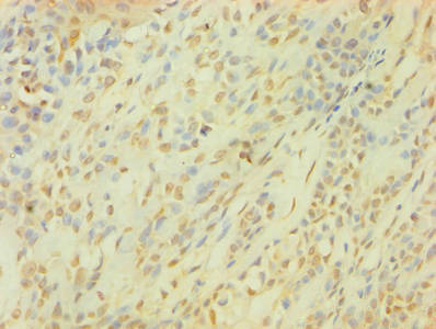 SNCG / Gamma-Synuclein Antibody - Immunohistochemistry of paraffin-embedded human breast cancer using SNCG Antibody at dilution of 1:100