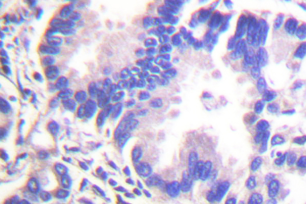 SNCG / Gamma-Synuclein Antibody - IHC of Synuclein (A111) pAb in paraffin-embedded human lung carcinoma tissue.