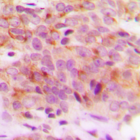 SNCG / Gamma-Synuclein Antibody - Immunohistochemical analysis of Gamma-synuclein staining in human breast cancer formalin fixed paraffin embedded tissue section. The section was pre-treated using heat mediated antigen retrieval with sodium citrate buffer (pH 6.0). The section was then incubated with the antibody at room temperature and detected using an HRP conjugated compact polymer system. DAB was used as the chromogen. The section was then counterstained with hematoxylin and mounted with DPX.
