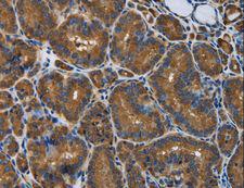 SNCG / Gamma-Synuclein Antibody - Immunohistochemistry of paraffin-embedded Human liver cancer using SNCG Polyclonal Antibody at dilution of 1:50.