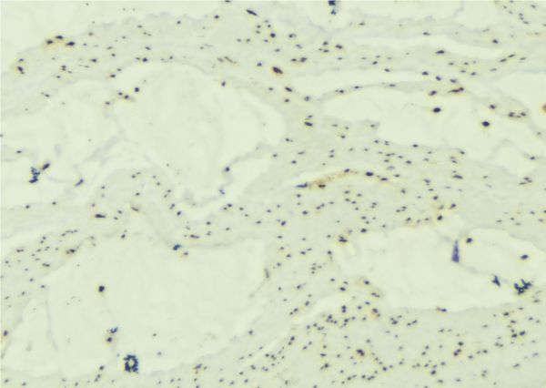 SNCG / Gamma-Synuclein Antibody - 1:100 staining mouse muscle tissue by IHC-P. The sample was formaldehyde fixed and a heat mediated antigen retrieval step in citrate buffer was performed. The sample was then blocked and incubated with the antibody for 1.5 hours at 22°C. An HRP conjugated goat anti-rabbit antibody was used as the secondary.