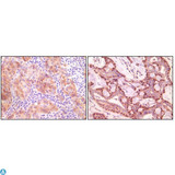SNCG / Gamma-Synuclein Antibody - Immunohistochemistry (IHC) analysis of paraffin-embedded Human Ovary carcinoma (left) and breast carcinoma (right), showing cytoplasmic(ovary carcinoma) localization, cytoplasmic and nuclear (breast carcinoma) localization with DAB staining using Synuclein-gamma Mo.