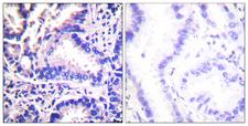 SNCG / Gamma-Synuclein Antibody - Peptide - + Immunohistochemical analysis of paraffin-embedded human lung carcinoma tissue using Synuclein ? Antibody.
