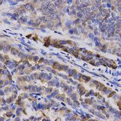 SNCG / Gamma-Synuclein Antibody - Immunohistochemistry of paraffin-embedded Human thyroid cancer using SNCG Polyclonal Antibody at dilution of 1:200 (40x lens).