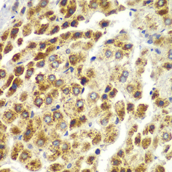 SND1 Antibody - Immunohistochemistry of paraffin-embedded human liver cancer tissue.