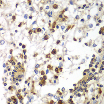 SND1 Antibody - Immunohistochemistry of paraffin-embedded human kidney cancer tissue.