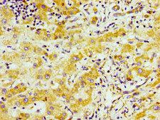 SND1 Antibody - Immunohistochemistry image of paraffin-embedded human liver cancer at a dilution of 1:100