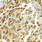 SND1 Antibody - Immunohistochemistry of paraffin-embedded human liver cancer using SND1 antibody at dilution of 1:100 (40x lens).
