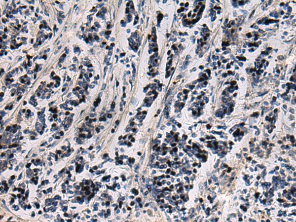 SNIP1 Antibody - Immunohistochemistry of paraffin-embedded Human breast cancer tissue  using SNIP1 Polyclonal Antibody at dilution of 1:80(×200)