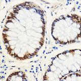 SNIP1 Antibody - Immunohistochemistry of paraffin-embedded Human colon carcinoma using SNIP1 Polyclonal Antibody at dilution of 1:100 (40x lens).