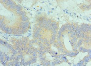 SNK / PLK2 Antibody - Immunohistochemistry of paraffin-embedded human colon cancer using antibody at 1:100 dilution.