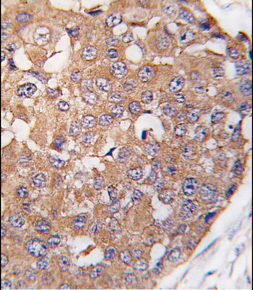 SNK / PLK2 Antibody - Formalin-fixed and paraffin-embedded human breast carcinoma tissue reacted with SNK Antibody (C-term ) , which was peroxidase-conjugated to the secondary antibody, followed by DAB staining. This data demonstrates the use of this antibody for immunohistochemistry; clinical relevance has not been evaluated.