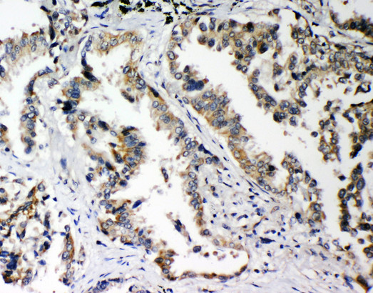 SNK / PLK2 Antibody - SNK / PLK2 antibody. IHC(P): Human Lung Cancer Tissue.