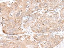 SNRNP25 Antibody - Immunohistochemistry of paraffin-embedded Human esophagus cancer tissue  using SNRNP25 Polyclonal Antibody at dilution of 1:65(×200)