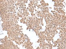 SNRNP25 Antibody - Immunohistochemistry of paraffin-embedded Human ovarian cancer tissue  using SNRNP25 Polyclonal Antibody at dilution of 1:55(×200)