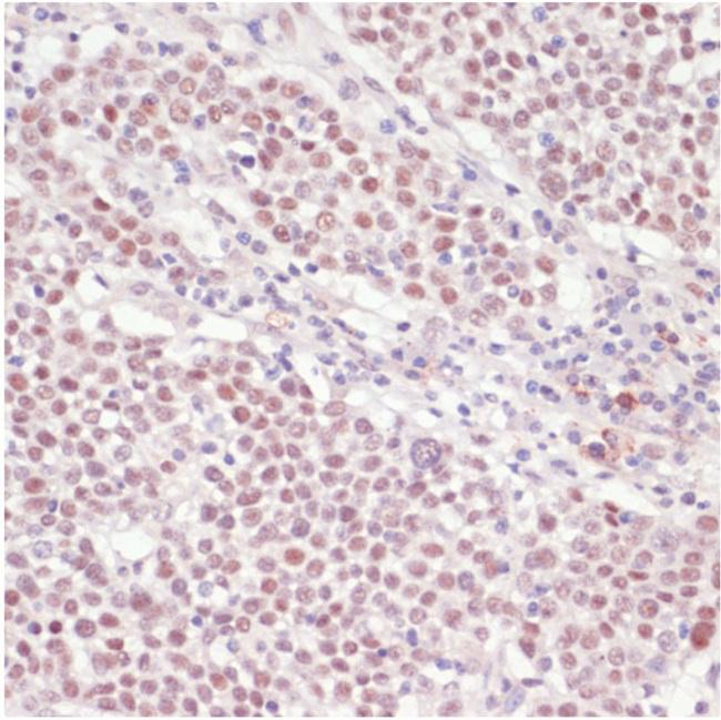 SNRP70 / SNRNP70 Antibody - Immunohistochemistry of paraffin-embedded human cervix cancer using SNRNP70 antibody at dilution of 1:100 (40x lens).