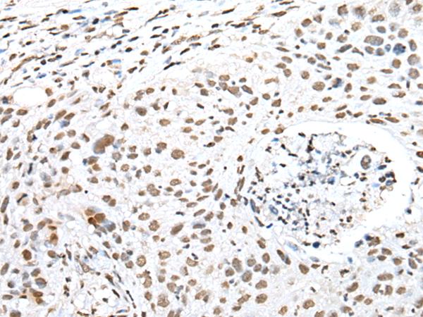 SNRPA / U1A Antibody - Immunohistochemistry of paraffin-embedded Human lung cancer tissue  using SNRPA Polyclonal Antibody at dilution of 1:30(×200)