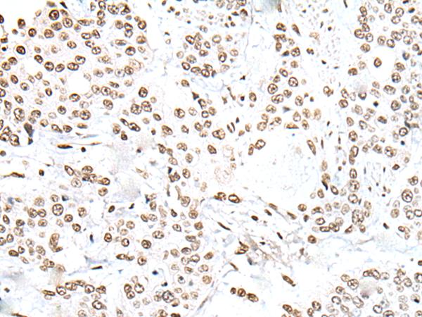 SNRPA / U1A Antibody - Immunohistochemistry of paraffin-embedded Human prost ate cancer tissue  using SNRPA Polyclonal Antibody at dilution of 1:30(×200)
