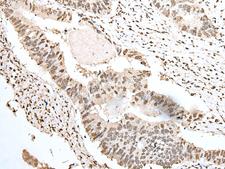 SNRPA / U1A Antibody - Immunohistochemistry of paraffin-embedded Human colorectal cancer tissue  using SNRPA Polyclonal Antibody at dilution of 1:55(×200)
