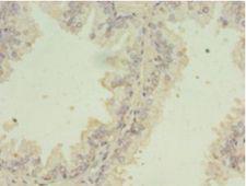 SNRPB2 Antibody - Immunohistochemistry of paraffin-embedded human prostate cancer using antibody at 1:100 dilution.  This image was taken for the unconjugated form of this product. Other forms have not been tested.