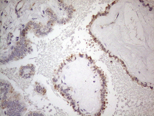 SNRPB2 Antibody - Immunohistochemical staining of paraffin-embedded Carcinoma of Human thyroid tissue using anti-SNRPB2 mouse monoclonal antibody. (Heat-induced epitope retrieval by 1mM EDTA in 10mM Tris buffer. (pH8.5) at 120°C for 3 min. (1:150)