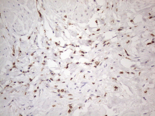 SNRPB2 Antibody - Immunohistochemical staining of paraffin-embedded Carcinoma of Human bladder tissue using anti-SNRPB2 mouse monoclonal antibody. (Heat-induced epitope retrieval by 1mM EDTA in 10mM Tris buffer. (pH8.5) at 120°C for 3 min. (1:150)
