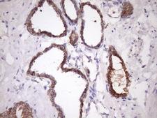 SNRPB2 Antibody - Immunohistochemical staining of paraffin-embedded Carcinoma of Human prostate tissue using anti-SNRPB2 mouse monoclonal antibody. (Heat-induced epitope retrieval by Tris-EDTA, pH8.0)(1:150)