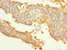 SNRPB2 Antibody - Immunohistochemistry of paraffin-embedded human cervical cancer at dilution 1:100