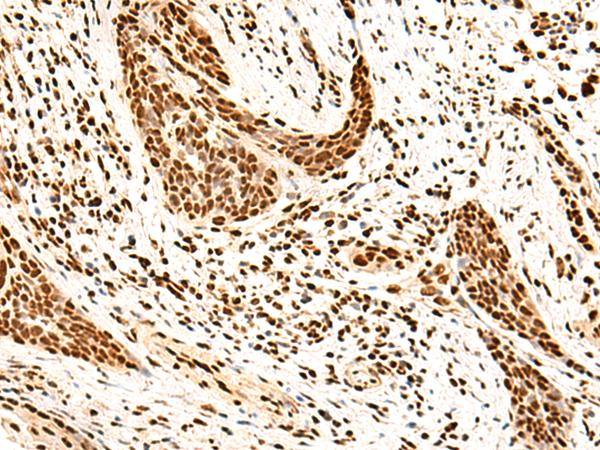 SNRPB2 Antibody - Immunohistochemistry of paraffin-embedded Human esophagus cancer tissue  using SNRPB2 Polyclonal Antibody at dilution of 1:75(×200)