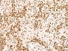 SNRPB2 Antibody - Immunohistochemistry of paraffin-embedded Human ovarian cancer tissue  using SNRPB2 Polyclonal Antibody at dilution of 1:90(×200)