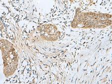 SNRPD1 / SMD1 Antibody - Immunohistochemistry of paraffin-embedded Human esophagus cancer tissue  using SNRPD1 Polyclonal Antibody at dilution of 1:70(×200)