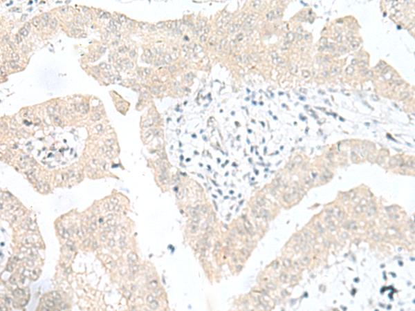 SNRPD1 / SMD1 Antibody - Immunohistochemistry of paraffin-embedded Human liver cancer tissue  using SNRPD1 Polyclonal Antibody at dilution of 1:30(×200)