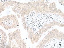 SNRPD1 / SMD1 Antibody - Immunohistochemistry of paraffin-embedded Human liver cancer tissue  using SNRPD1 Polyclonal Antibody at dilution of 1:30(×200)