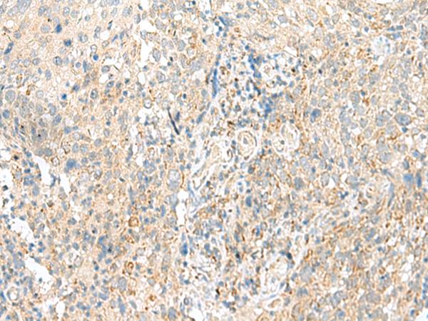 SNRPD1 / SMD1 Antibody - Immunohistochemistry of paraffin-embedded Human cervical cancer tissue  using SNRPD1 Polyclonal Antibody at dilution of 1:30(×200)