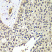 SNRPD2 Antibody - Immunohistochemistry of paraffin-embedded human lung cancer tissue.