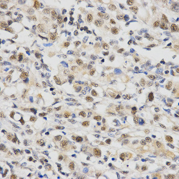SNRPE Antibody - Immunohistochemistry of paraffin-embedded human stomach cancer tissue.