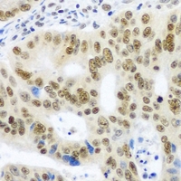 SNRPE Antibody - Immunohistochemical analysis of Sm E staining in human colon cancer formalin fixed paraffin embedded tissue section. The section was pre-treated using heat mediated antigen retrieval with sodium citrate buffer (pH 6.0). The section was then incubated with the antibody at room temperature and detected using an HRP conjugated compact polymer system. DAB was used as the chromogen. The section was then counterstained with hematoxylin and mounted with DPX.