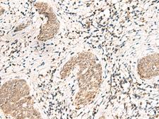 SNRPG Antibody - Immunohistochemistry of paraffin-embedded Human esophagus cancer tissue  using SNRPG Polyclonal Antibody at dilution of 1:40(×200)