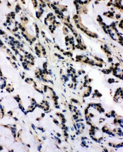 SNRPN Antibody - SNRPN antibody. IHC(P): Human Intestinal Cancer Tissue.