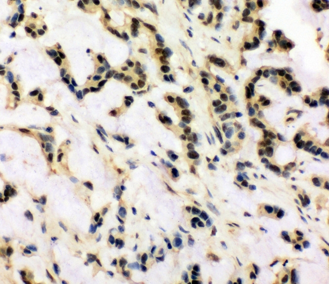 SNRPN Antibody - IHC analysis of SNRPN using anti-SNRPN antibody. SNRPN was detected in paraffin-embedded section of human intestinal cancer tissue. Heat mediated antigen retrieval was performed in citrate buffer (pH6, epitope retrieval solution) for 20 mins. The tissue section was blocked with 10% goat serum. The tissue section was then incubated with 1µg/ml rabbit anti-SNRPN Antibody overnight at 4°C. Biotinylated goat anti-rabbit IgG was used as secondary antibody and incubated for 30 minutes at 37°C. The tissue section was developed using Strepavidin-Biotin-Complex (SABC) with DAB as the chromogen.