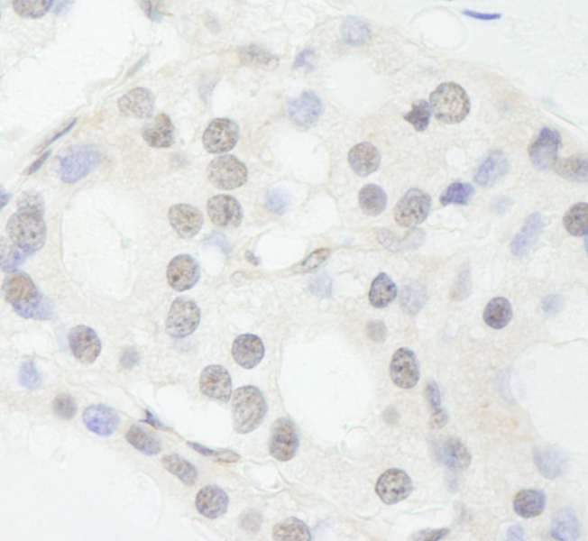 SNW1 / SKIP Antibody - Detection of Human NCOA62 by Immunohistochemistry. Sample: FFPE section of human thyroid carcinoma. Antibody: Affinity purified rabbit anti-NCOA62 used at a dilution of 1:250.